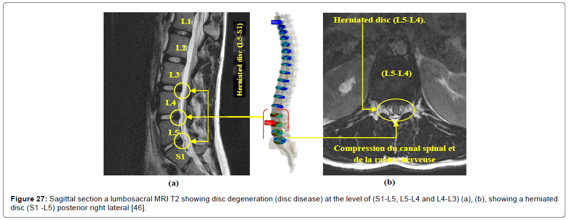 advances-cancer-prevention-disc-disease