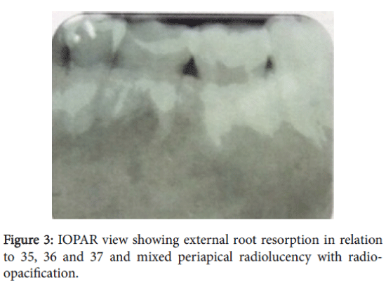 advances-cancer-prevention-external-root