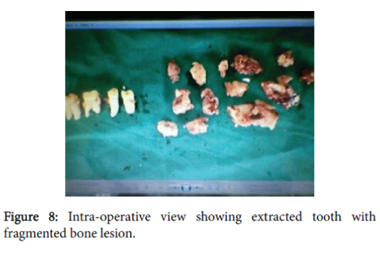 advances-cancer-prevention-fragmented-bone-lesion
