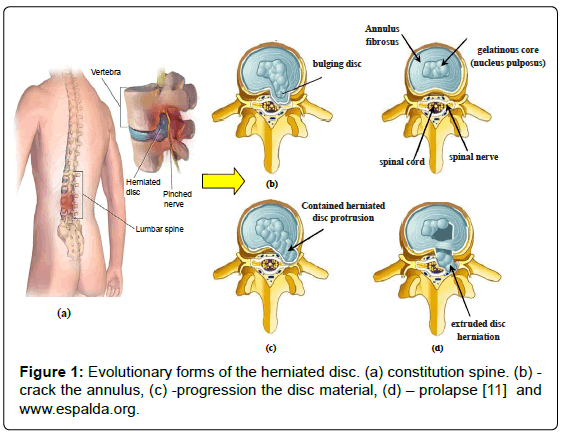 advances-cancer-prevention-herniated-disc