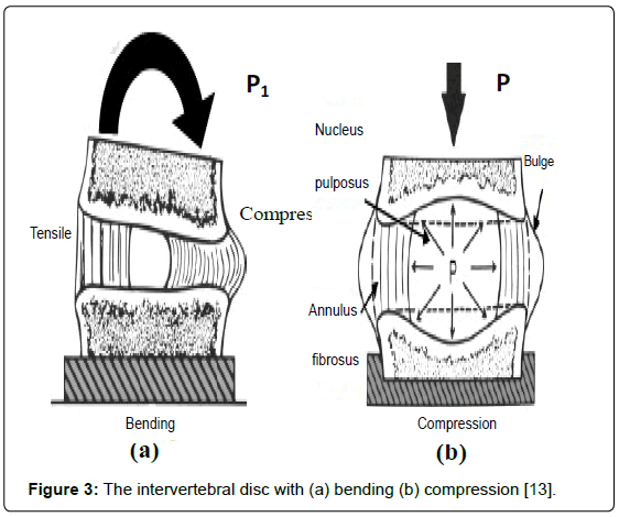advances-cancer-prevention-intervertebral-disc