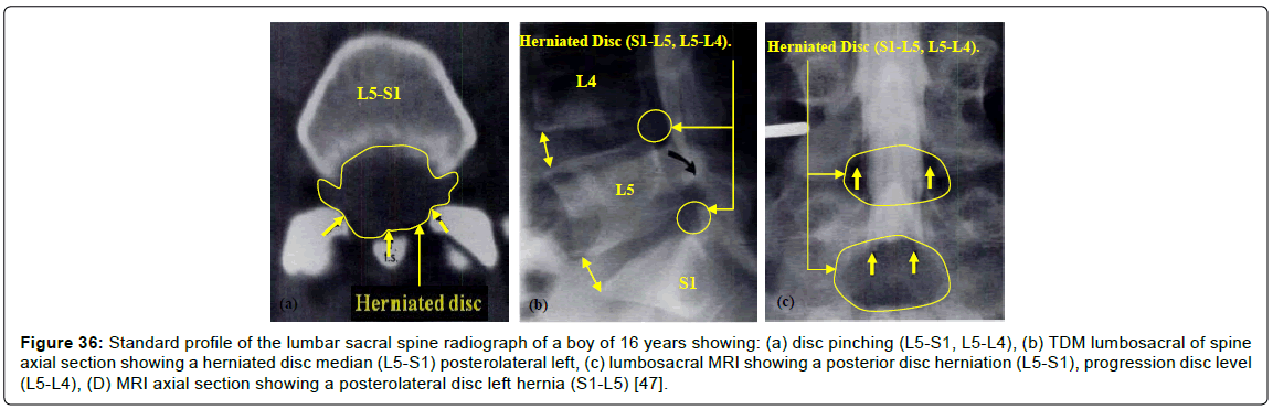 advances-cancer-prevention-lumbar-sacral-spine