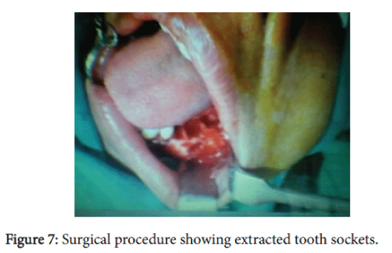 advances-cancer-prevention-tooth-sockets