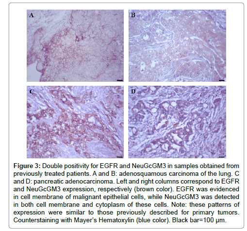 advances-molecular-diagnostics-adenosquamous-carcinoma-lung