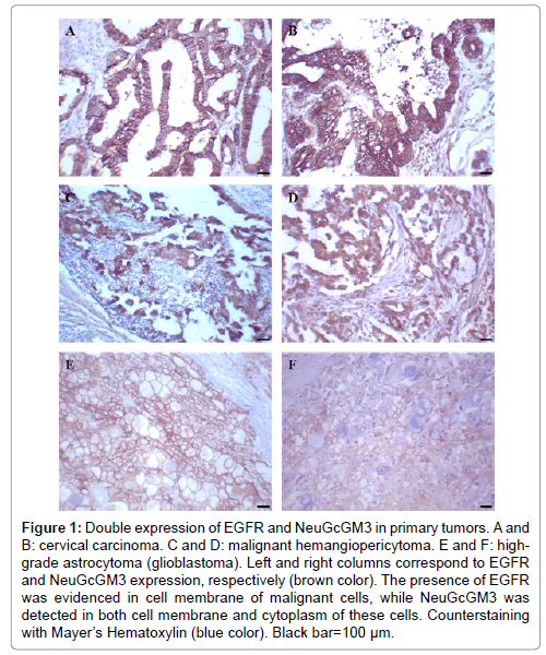 advances-molecular-diagnostics-malignant-hemangiopericytoma