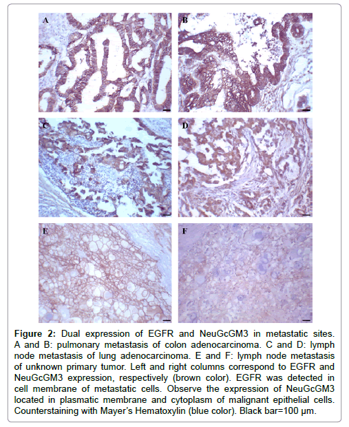 advances-molecular-diagnostics-pulmonary-metastasis-colon-adenocarcinoma
