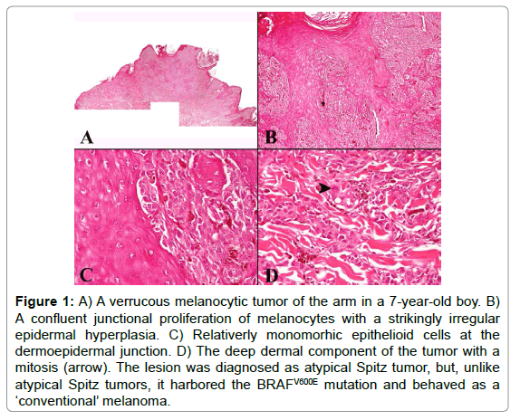 advances-molecular-diagnostics-verrucous-melanocytic-tumor