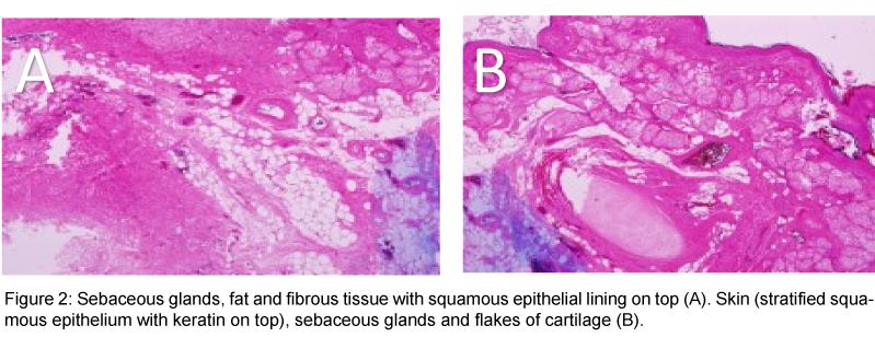 advances-oncology-research-and-treatments-Sebaceous-glands