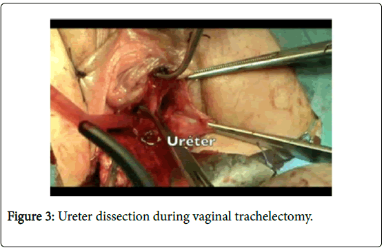 advances-oncology-research-ureter-dissection-during-vaginal