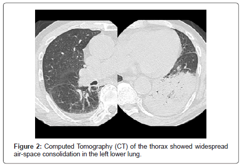 air-water-borne-diseases-computed-tomography