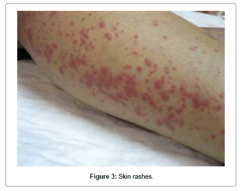 air-water-borne-diseases-rashes