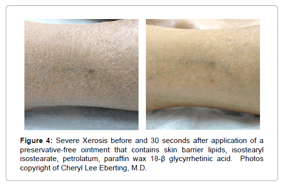 Nicomide chin rash allergy