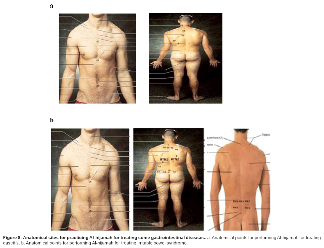 anatomical sites for practicing wet cupping therapy al hijamah in