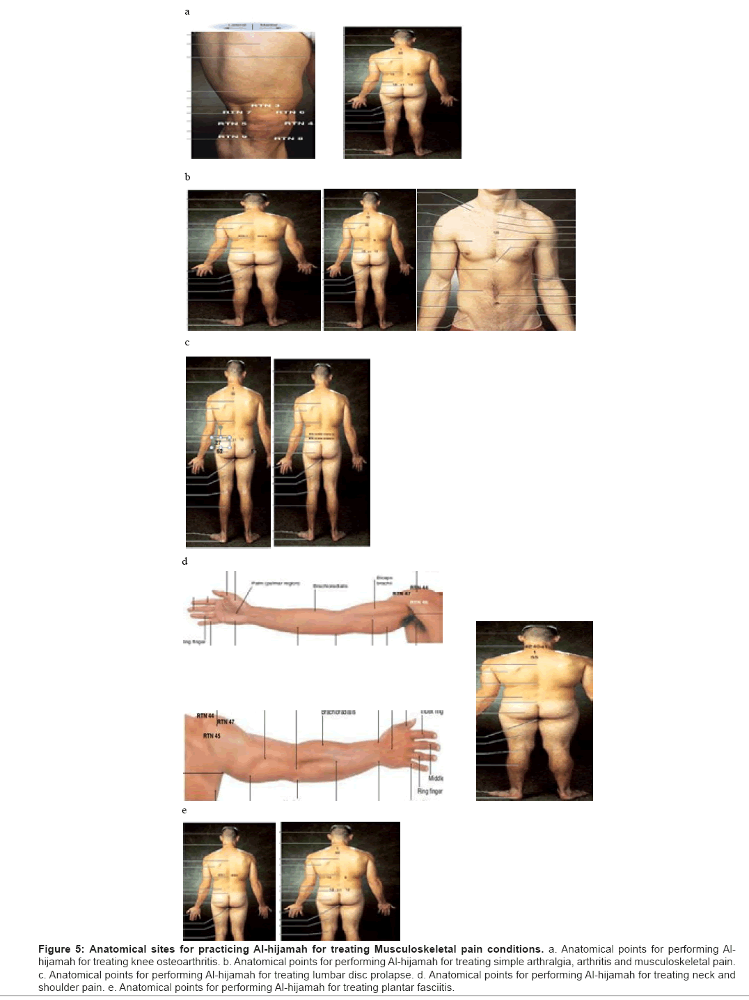 Hijama Cupping Points Chart