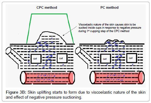 Cupping Chart Pdf