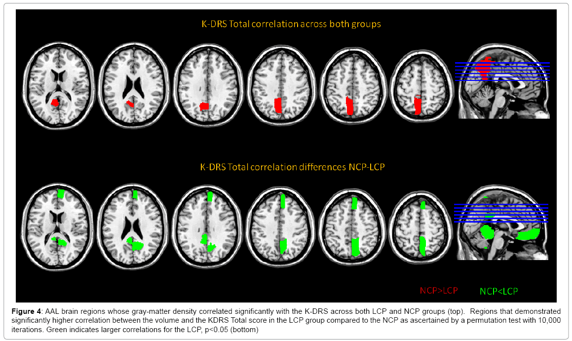alzheimers-disease-parkinsonism-AAL-brain