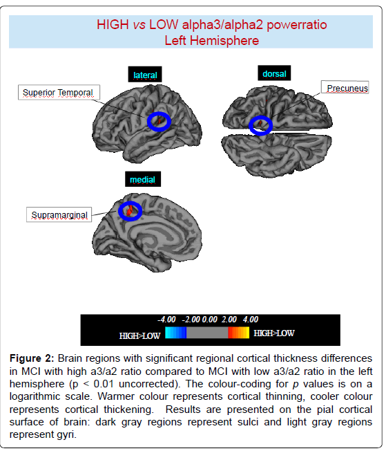 alzheimers-disease-parkinsonism-Brain-regions