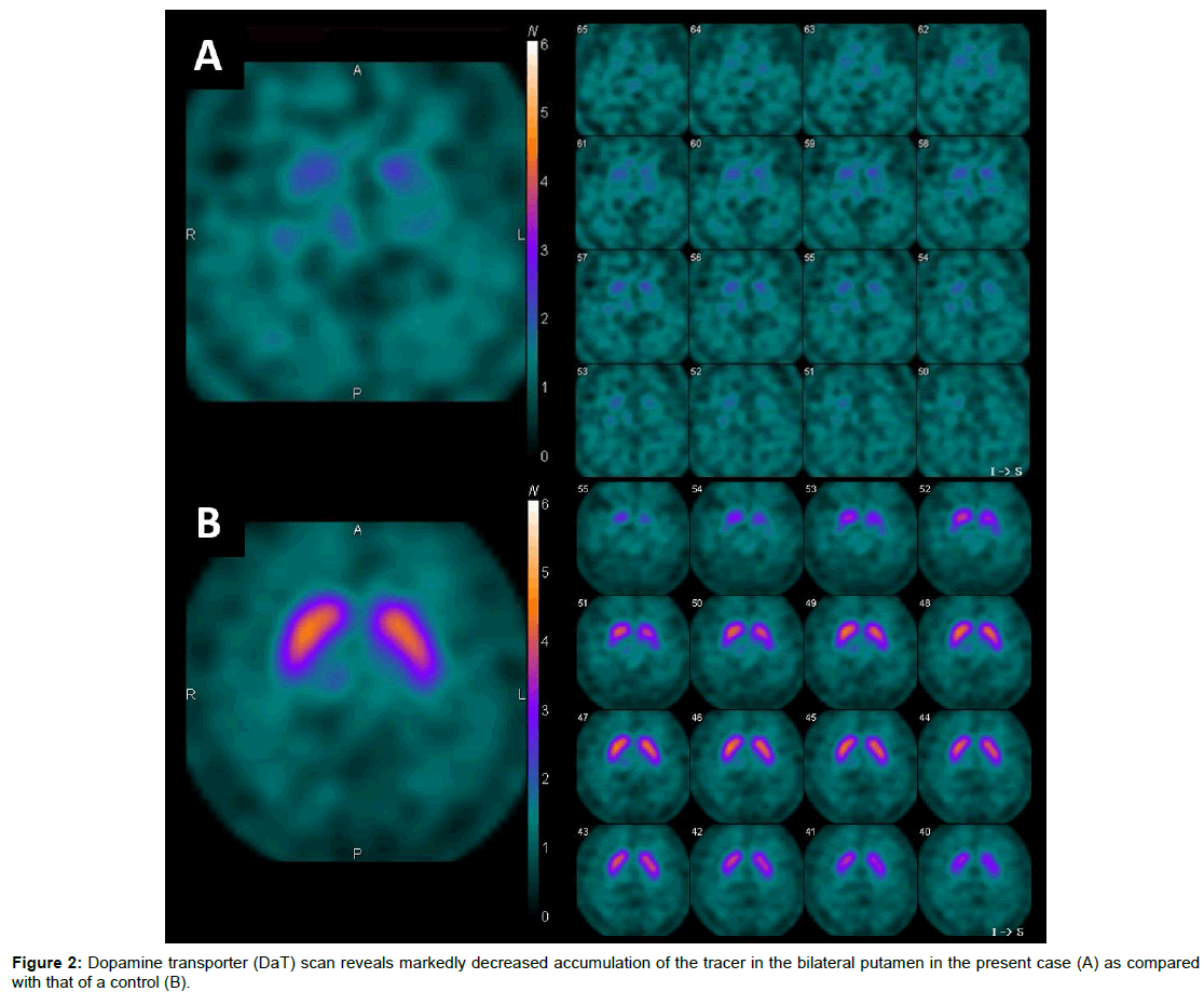 alzheimers-disease-parkinsonism-Dopamine-transporter