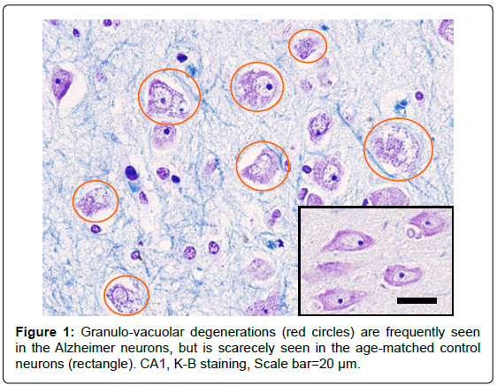 alzheimers-disease-parkinsonism-Granulo-vacuolar