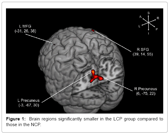 alzheimers-disease-parkinsonism-LCP-group