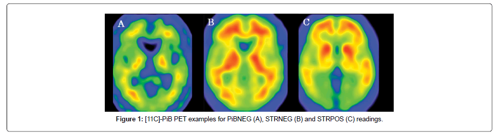 alzheimers-disease-parkinsonism-STRNEG-STRPOS