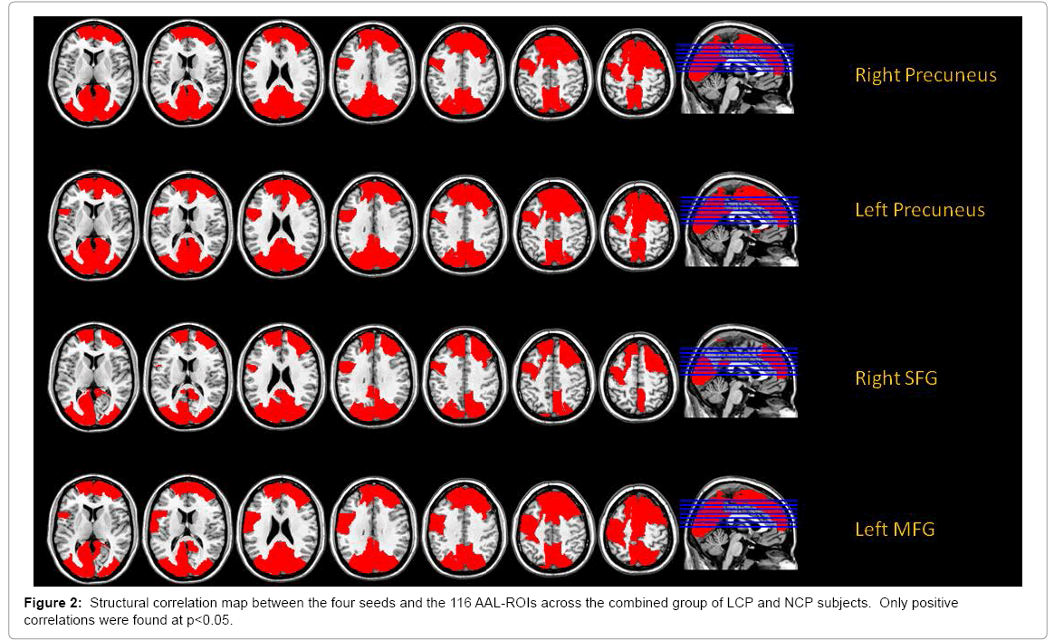 alzheimers-disease-parkinsonism-Structural-correlation