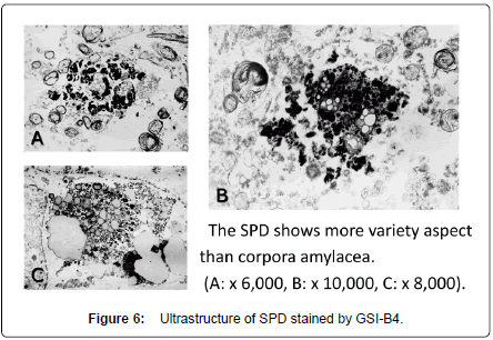 alzheimers-disease-parkinsonism-Ultrastructure-SPD