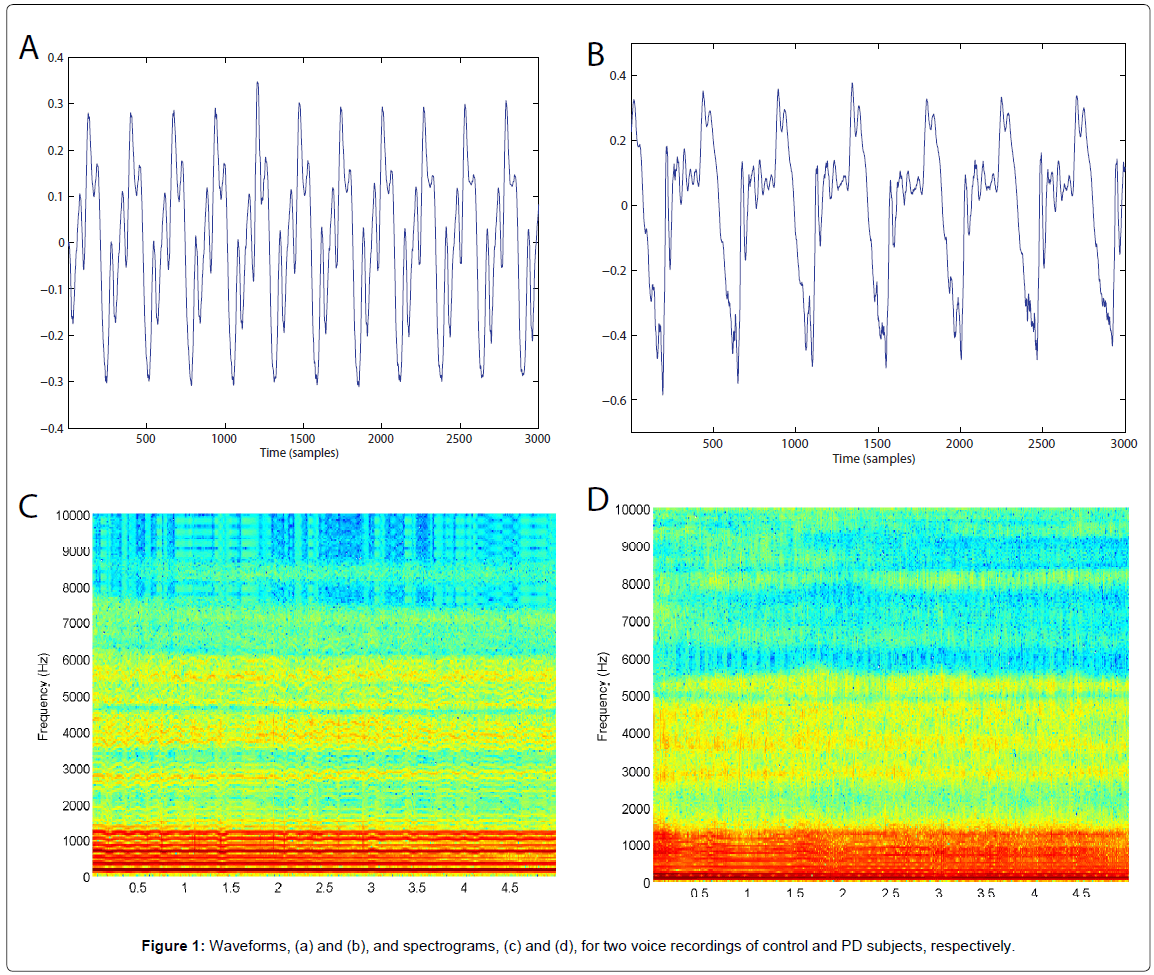 alzheimers-disease-parkinsonism-Waveforms-spectrograms
