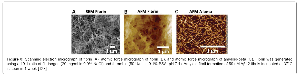 alzheimers-disease-parkinsonism-amyloid-beta