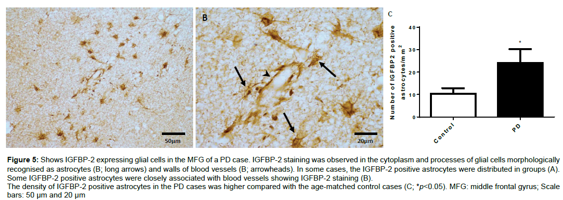 alzheimers-disease-parkinsonism-blood-vessels