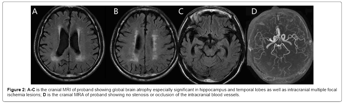 alzheimers-disease-parkinsonism-brain-atrophy