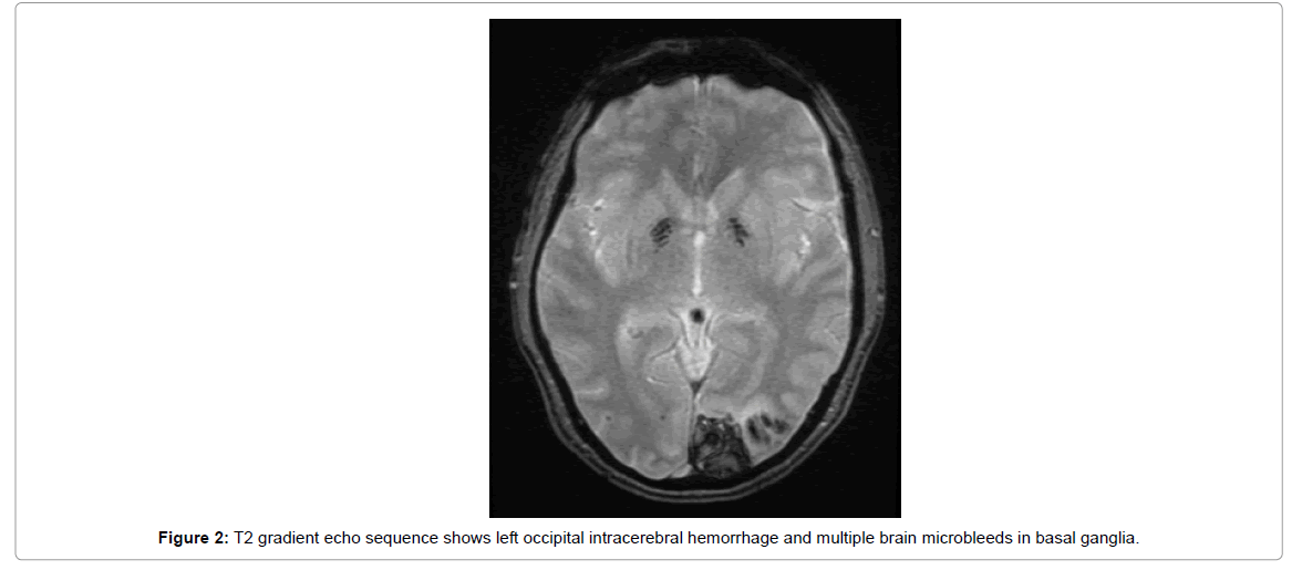 alzheimers-disease-parkinsonism-brain-microbleeds