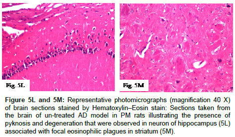 alzheimers-disease-parkinsonism-eosinophilic-plagues