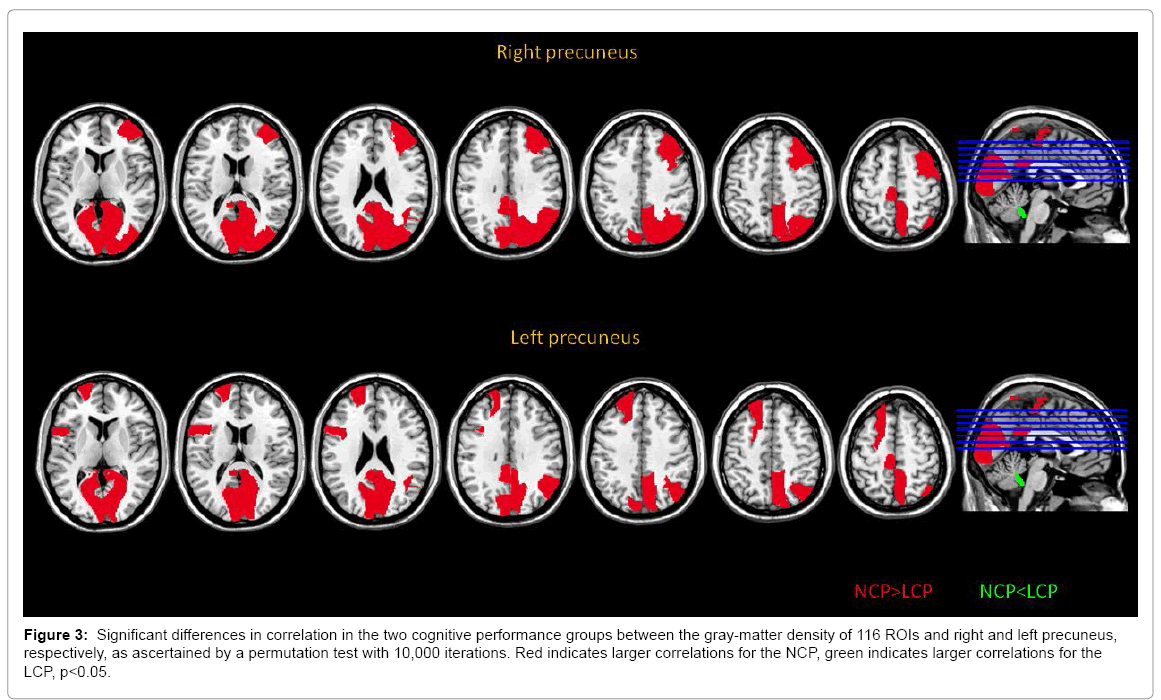 alzheimers-disease-parkinsonism-gray-matter-density