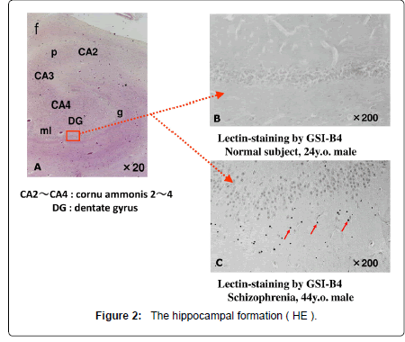 alzheimers-disease-parkinsonism-hippocampal-formation