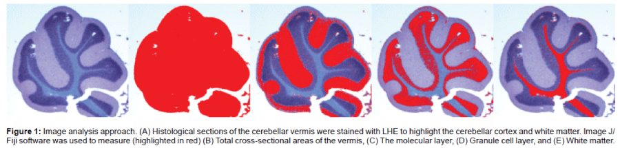 alzheimers-disease-parkinsonism-histological-sections