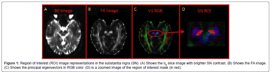 alzheimers-disease-parkinsonism-interest-mask