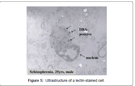 alzheimers-disease-parkinsonism-lectin-stained