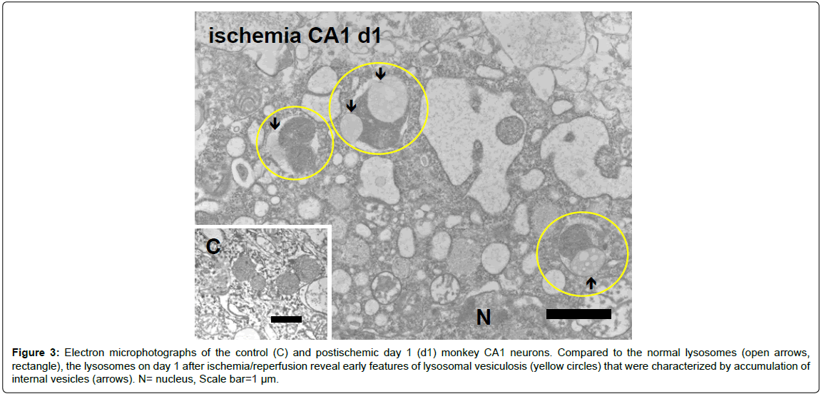 alzheimers-disease-parkinsonism-lysosomal-vesiculosis