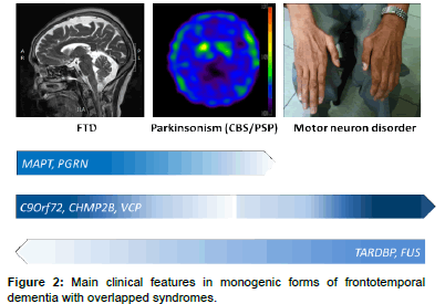 alzheimers-disease-parkinsonism-monogenic-forms