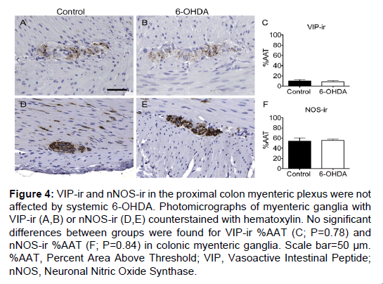 alzheimers-disease-parkinsonism-myenteric-plexus