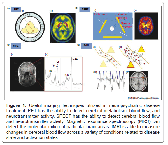 alzheimers-disease-parkinsonism-neuropsychiatric-disease