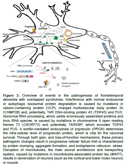 alzheimers-disease-parkinsonism-pathogenesis-frontotemporal