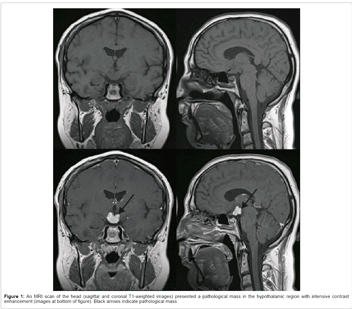 alzheimers-disease-parkinsonism-pathological-mass