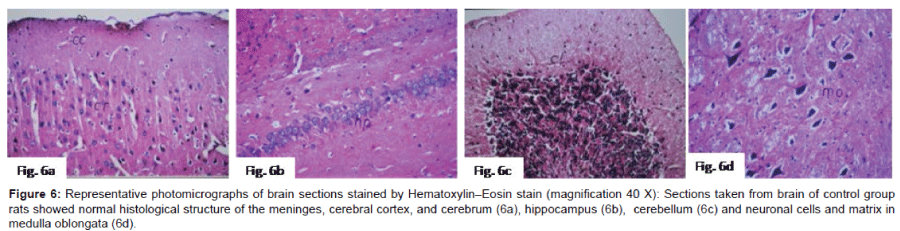 alzheimers-disease-parkinsonism-photomicrographs-brain