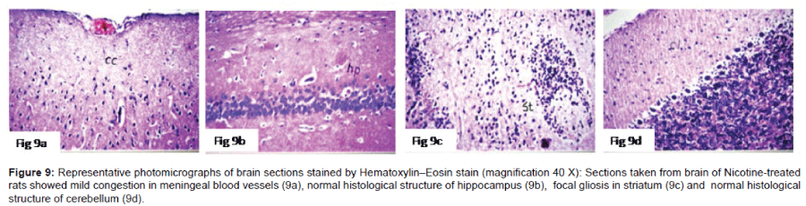 alzheimers-disease-parkinsonism-photomicrographs-brain