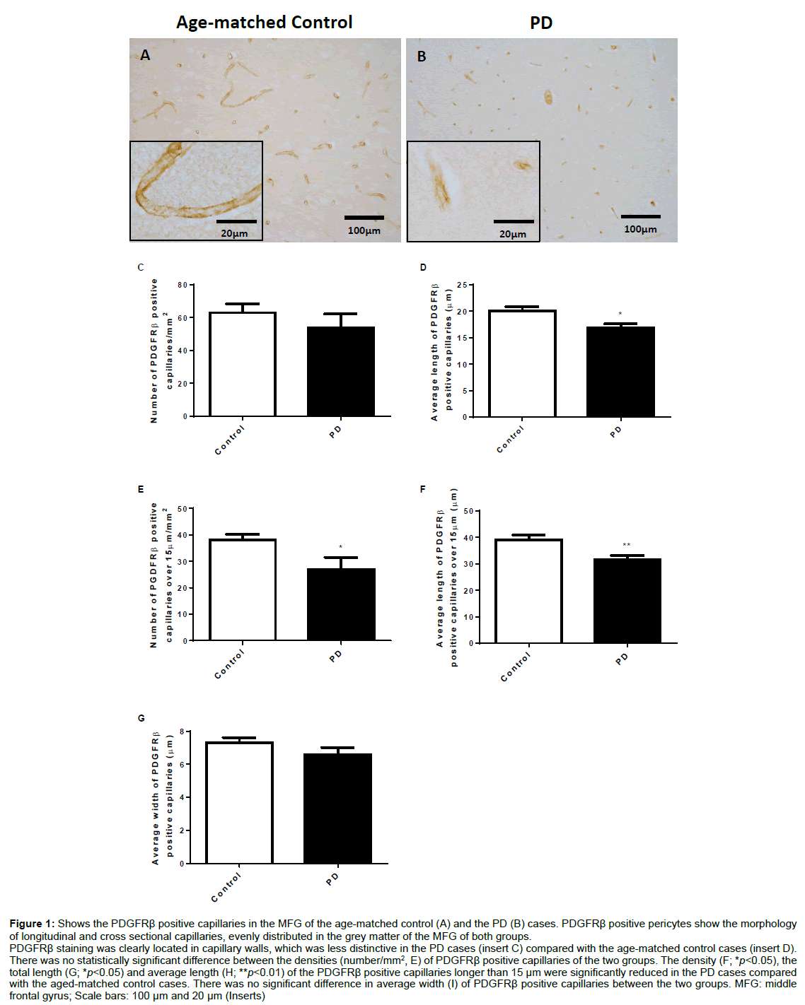 alzheimers-disease-parkinsonism-positive-capillaries
