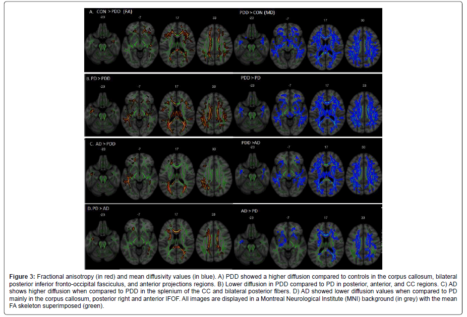 alzheimers-disease-parkinsonism-projections-regions