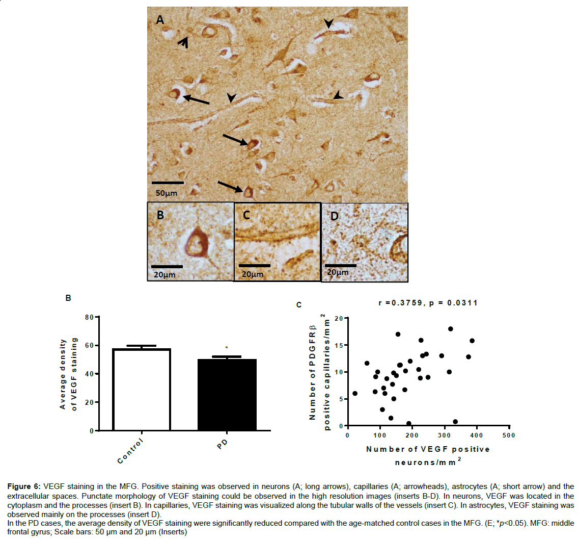 alzheimers-disease-parkinsonism-significantly-reduced