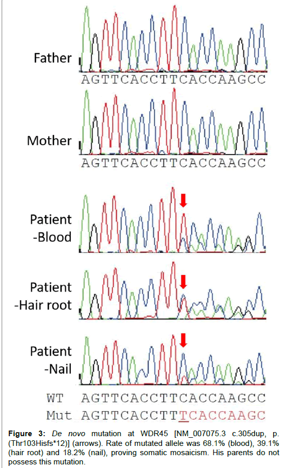 alzheimers-disease-parkinsonism-somatic-mosaicism